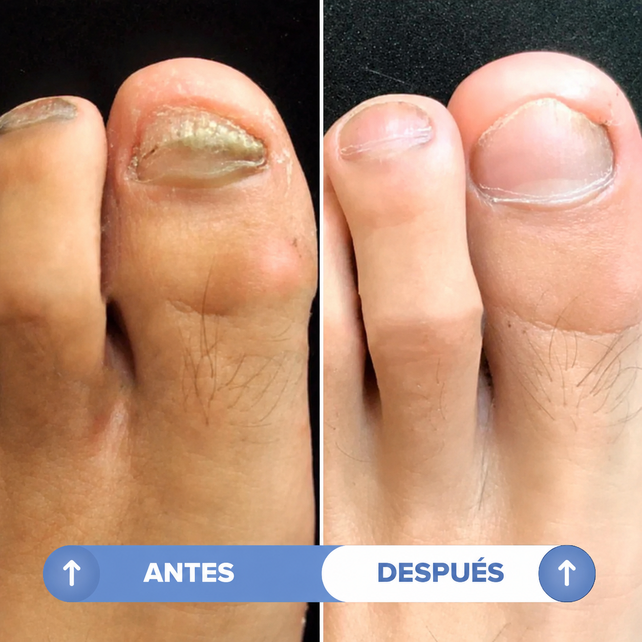 SENARA | Lápiz Antihongos