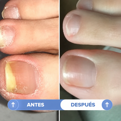 SENARA | Lápiz Antihongos